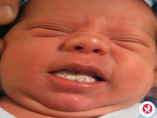 शिशुओं में ओरल थ्रश- कारण, इलाज और रोकथाम