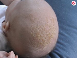 शिशुओं और बच्चों की त्वचा पर रैशेज से निपटने के लिए क्या करें